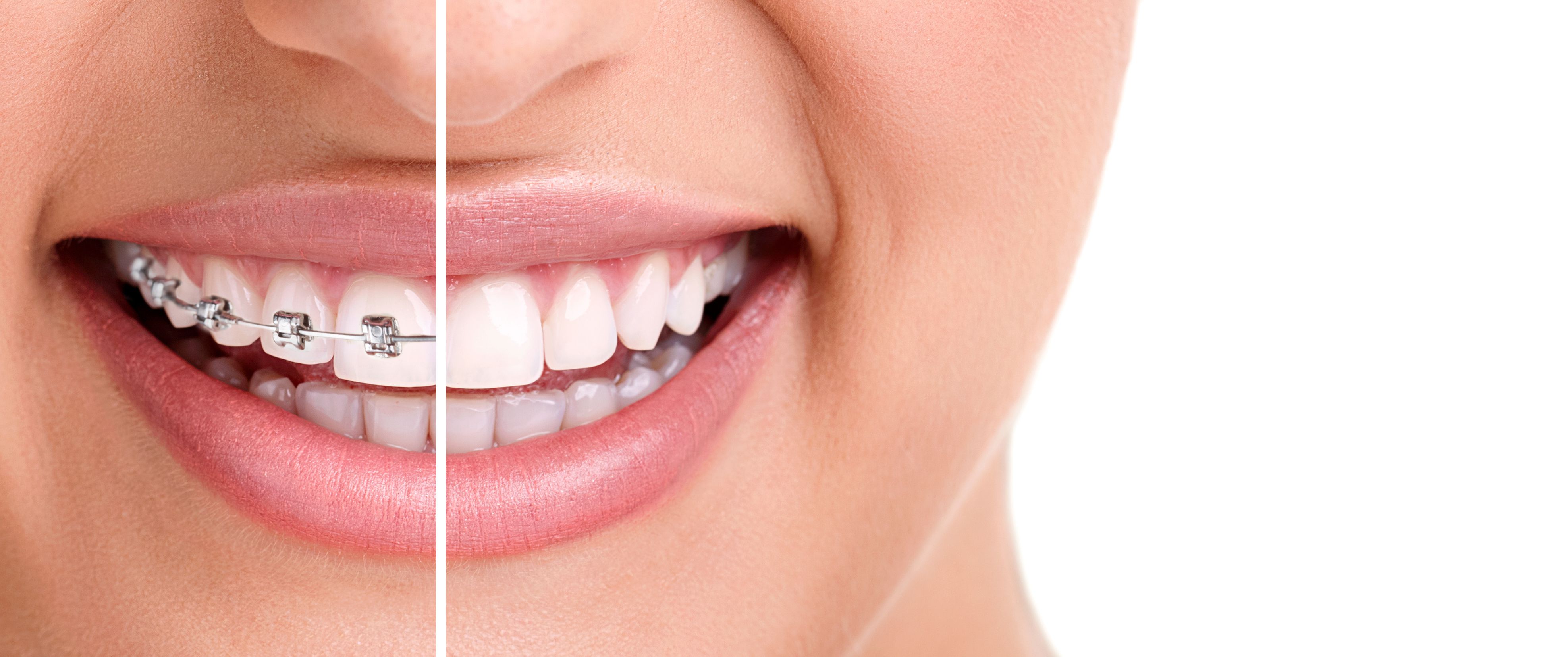 braces-ou-invisalign braces-ou-invisalign