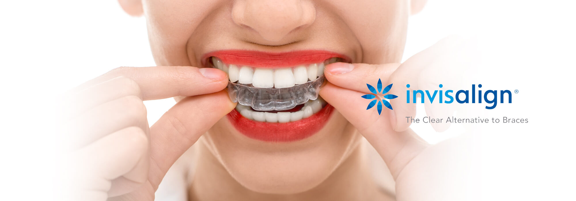 invisalign6 invisalign6